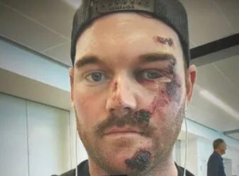  PGA TOUR’S GRAYSON MURRAY INJURED IN HORRIFIC SCOOTER ACCIDENT … Needed 50 Stitches