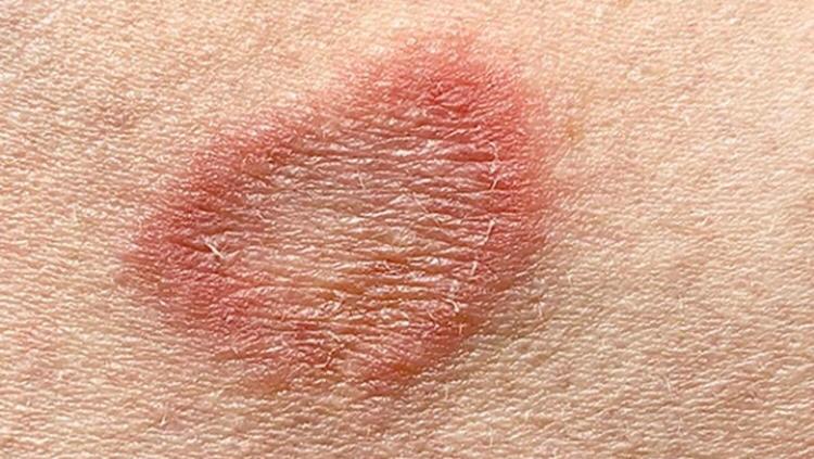  NYC reports treatment-resistant ringworm infections, first ever in the U.S.