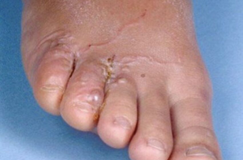 Health – Keeping Our Community Protected from Leptospirosis